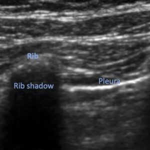 Pneumothorax After Endobronchial Ultrasound Image