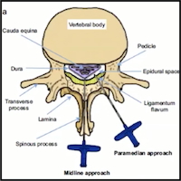 Spinal Pathologies in Obstetric Anesthesia