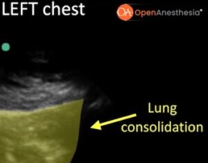 OA-POCUS Case of the Month: Lung Ultrasound