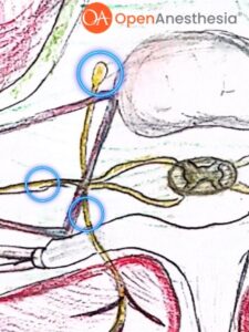 Approaches to the Thoracic Paravertebral Block